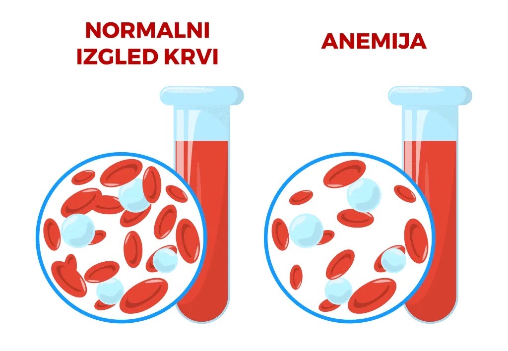 Sve o anemiji
