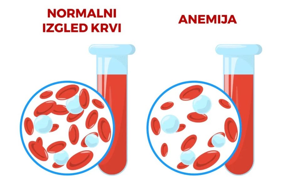 Sve o anemiji